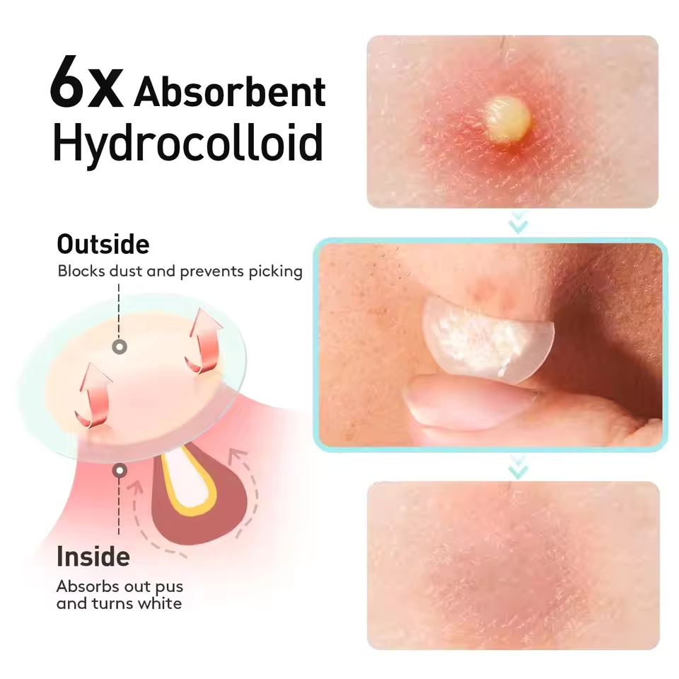 360 قطعة/صندوق رقع حب الشباب - - مراجعة Face Oil وسعره